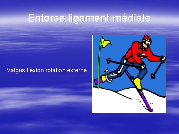 Entorse ligament médiale Valgus flexion rotation externe 