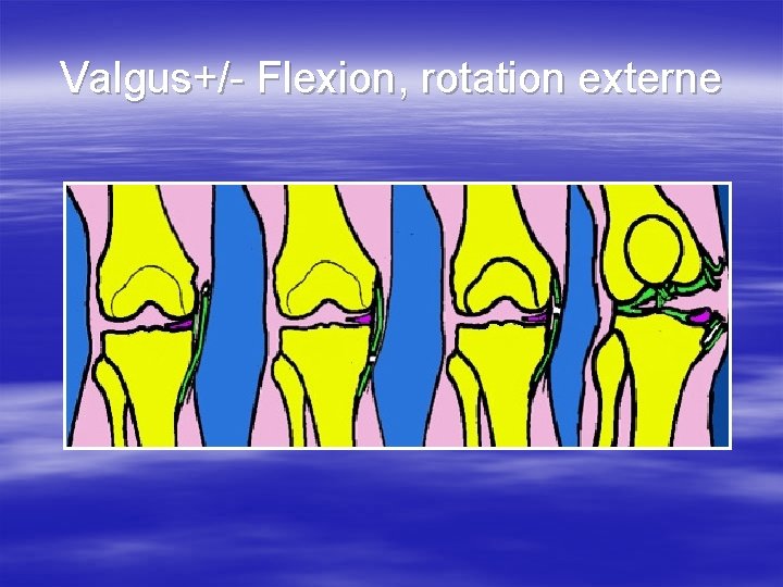 Valgus+/- Flexion, rotation externe 