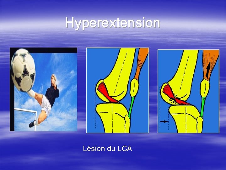 Hyperextension Lésion du LCA 