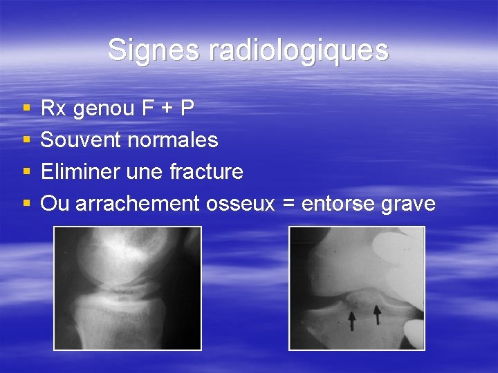 Signes radiologiques § § Rx genou F + P Souvent normales Eliminer une fracture