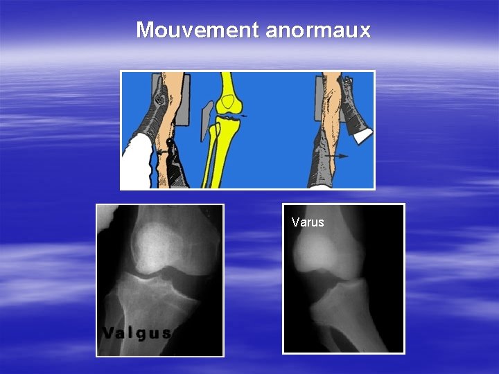 Mouvement anormaux Varus 