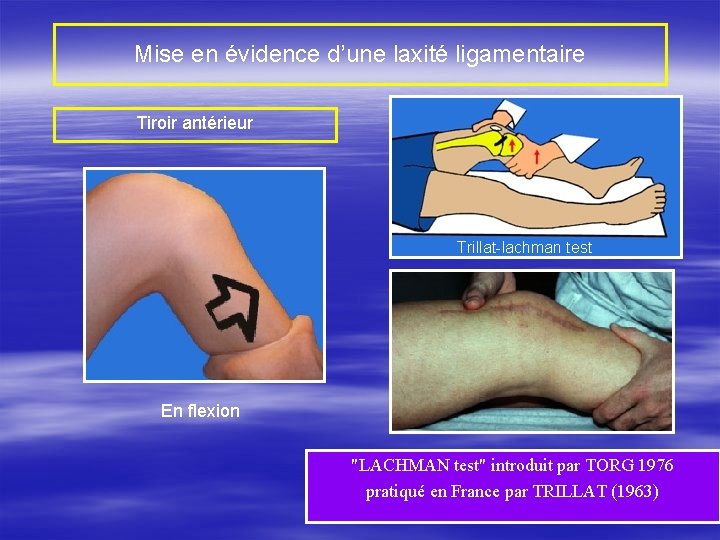 Mise en évidence d’une laxité ligamentaire Tiroir antérieur Trillat-lachman test En flexion "LACHMAN test"