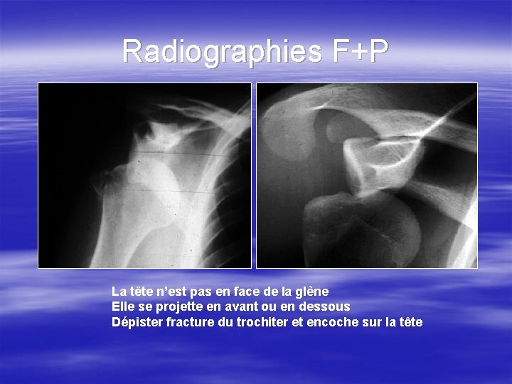 Radiographies F+P La tête n’est pas en face de la glène Elle se projette
