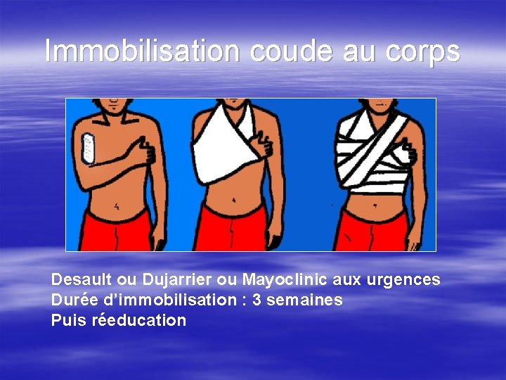 Immobilisation coude au corps Desault ou Dujarrier ou Mayoclinic aux urgences Durée d’immobilisation :