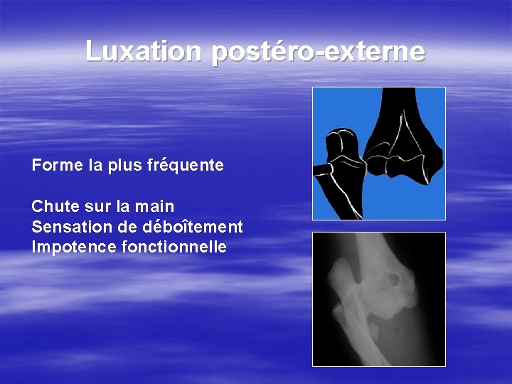 Luxation postéro-externe Forme la plus fréquente Chute sur la main Sensation de déboîtement Impotence