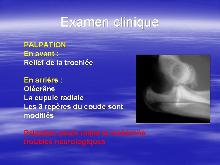 Examen clinique PALPATION En avant : Relief de la trochlée En arrière : Olécrâne