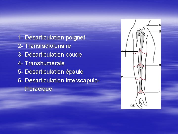 1 - Désarticulation poignet 2 - Transradiolunaire 3 - Désarticulation coude 4 - Transhumérale