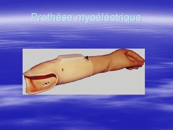 Prothèse myoéléctrique 