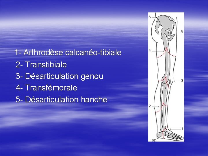 1 - Arthrodèse calcanéo-tibiale 2 - Transtibiale 3 - Désarticulation genou 4 - Transfémorale