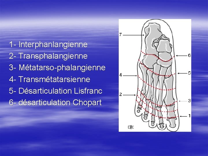 1 - Interphanlangienne 2 - Transphalangienne 3 - Métatarso-phalangienne 4 - Transmétatarsienne 5 -