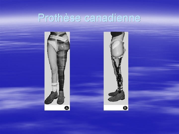 Prothèse canadienne 