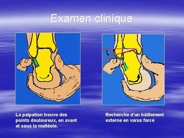 Examen clinique La palpation trouve des points douloureux, en avant et sous la malléole.