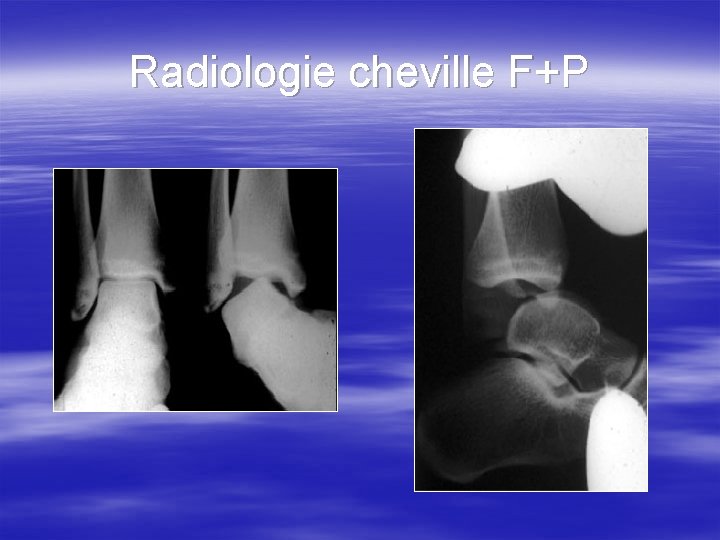 Radiologie cheville F+P 