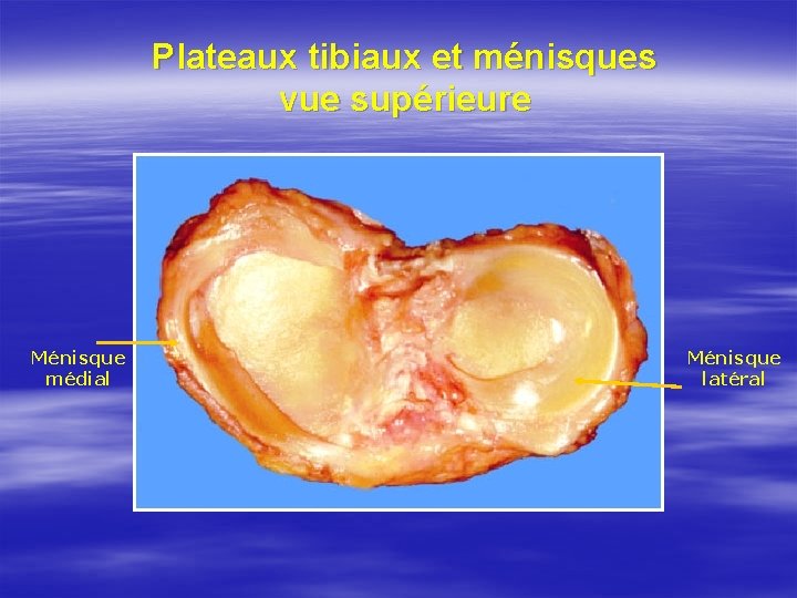 Plateaux tibiaux et ménisques vue supérieure Ménisque médial Ménisque latéral 