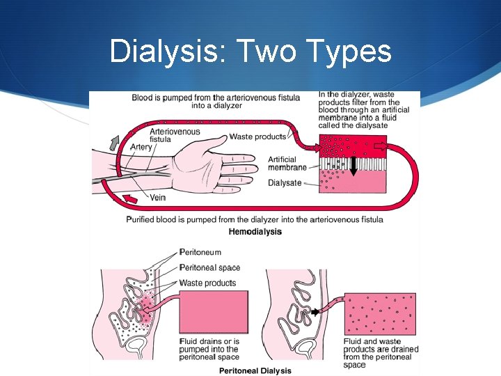 Dialysis: Two Types 