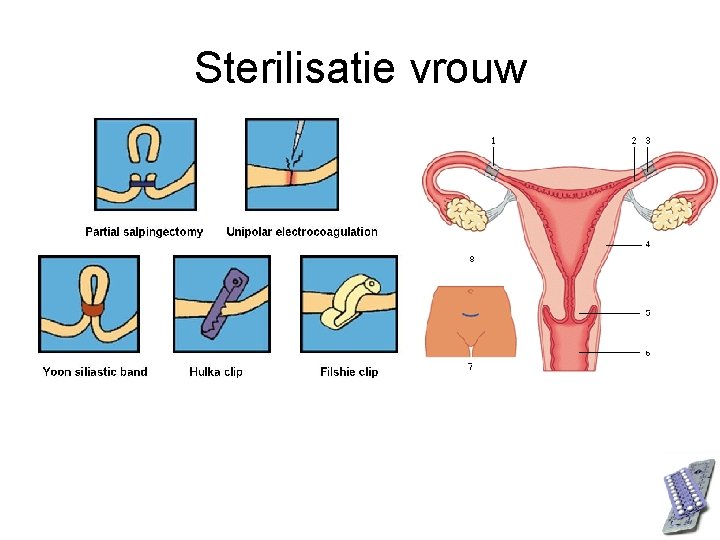 Sterilisatie vrouw 