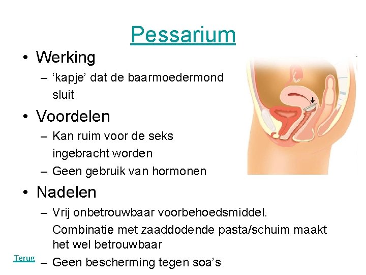 Pessarium • Werking – ‘kapje’ dat de baarmoedermond sluit • Voordelen – Kan ruim