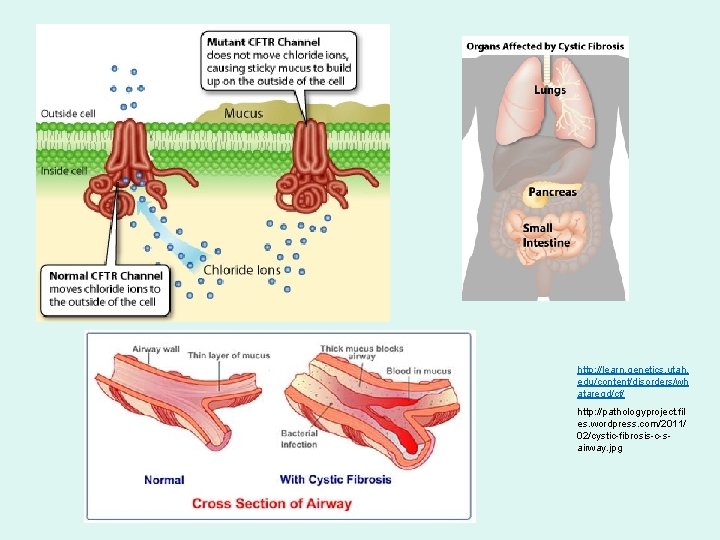 http: //learn. genetics. utah. edu/content/disorders/wh ataregd/cf/ http: //pathologyproject. fil es. wordpress. com/2011/ 02/cystic-fibrosis-c-sairway. jpg