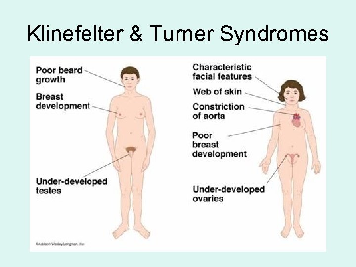 Klinefelter & Turner Syndromes 