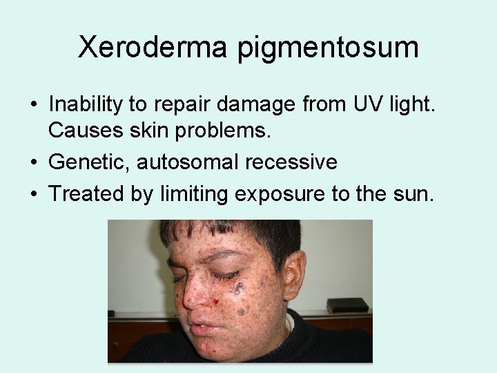 Xeroderma pigmentosum • Inability to repair damage from UV light. Causes skin problems. •