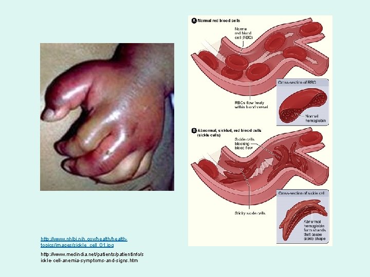 http: //www. nhlbi. nih. gov/healthtopics/images/sickle_cell_01. jpg http: //www. medindia. net/patients/patientinfo/s ickle-cell-anemia-symptoms-and-signs. htm 