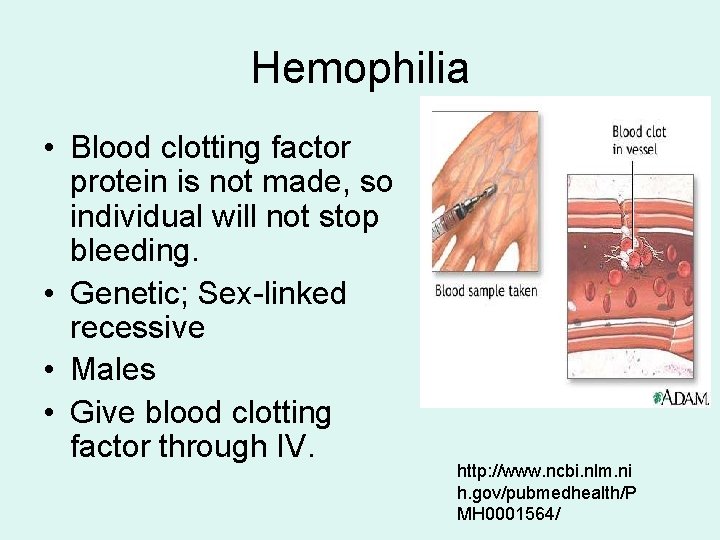 Hemophilia • Blood clotting factor protein is not made, so individual will not stop