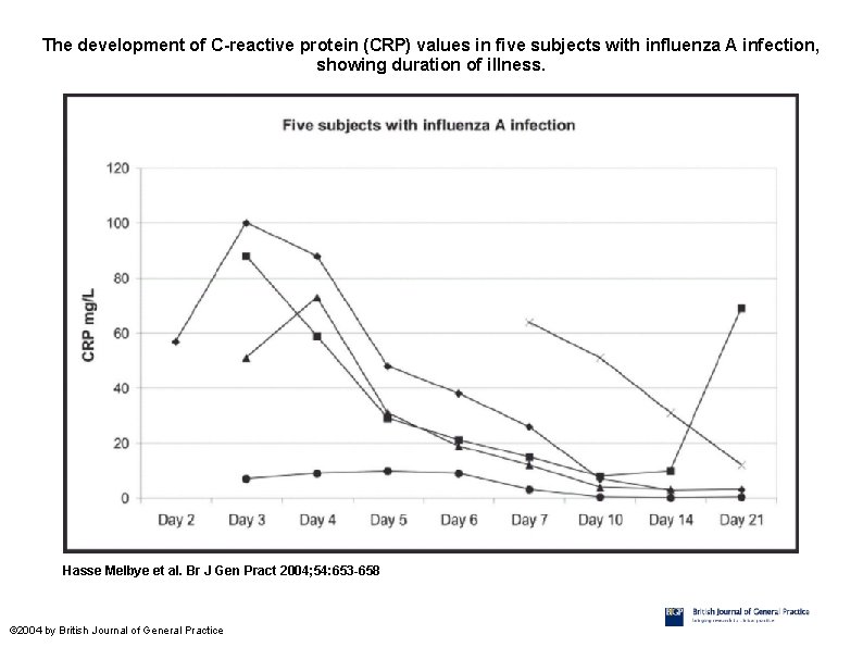 The development of C-reactive protein (CRP) values in five subjects with influenza A infection,