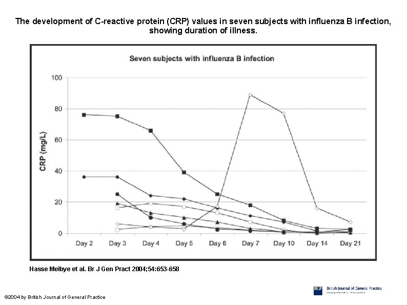 The development of C-reactive protein (CRP) values in seven subjects with influenza B infection,