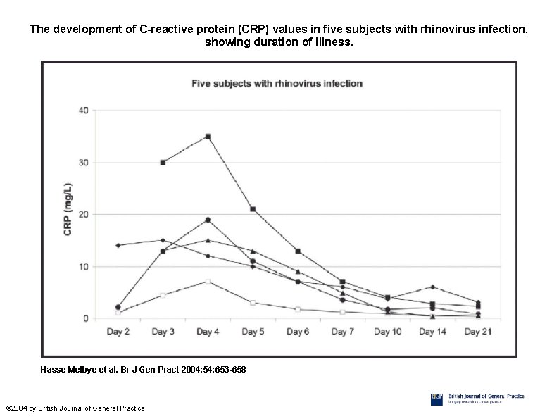 The development of C-reactive protein (CRP) values in five subjects with rhinovirus infection, showing
