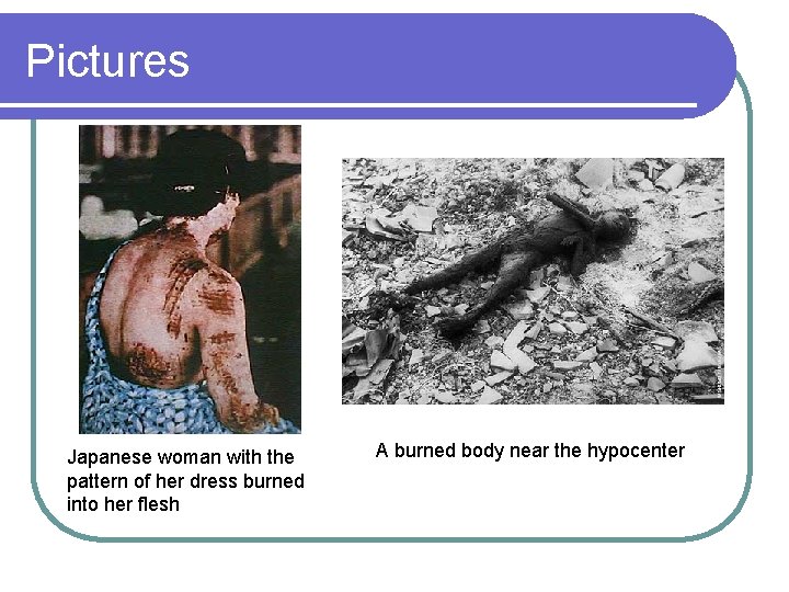 Pictures Japanese woman with the pattern of her dress burned into her flesh A