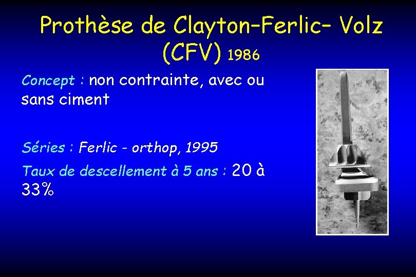 Prothèse de Clayton–Ferlic– Volz (CFV) 1986 Concept : non contrainte, avec ou sans ciment