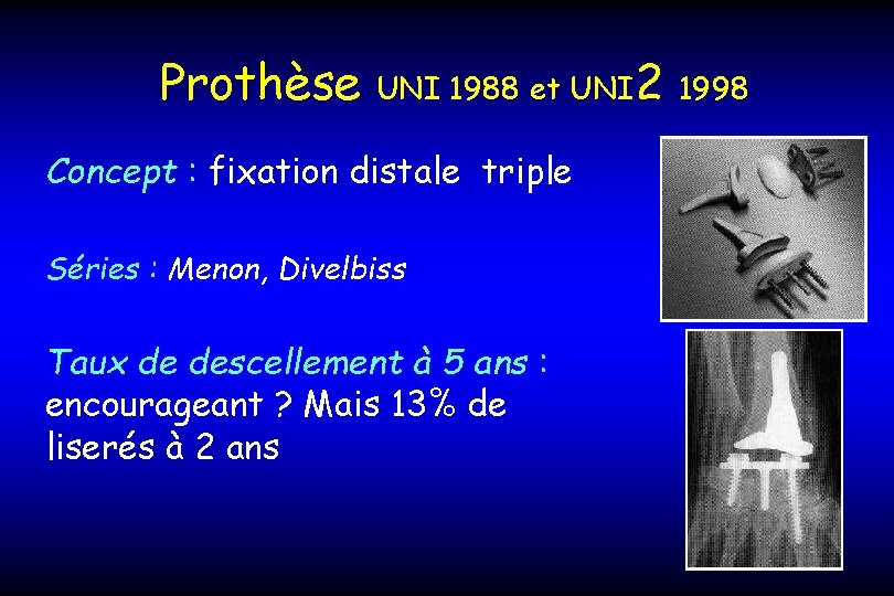 Prothèse UNI 1988 et UNI 2 1998 Concept : fixation distale triple Séries :