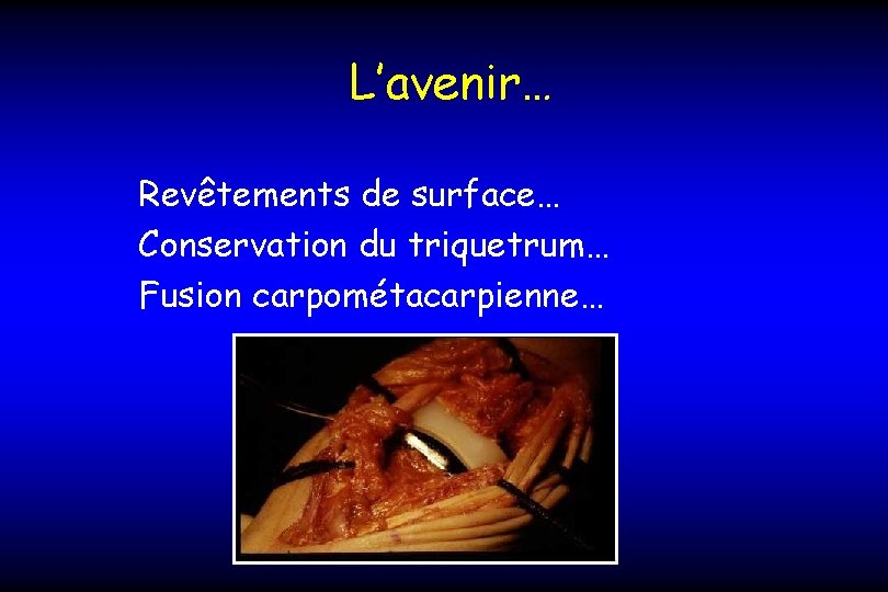 L’avenir… Revêtements de surface… Conservation du triquetrum… Fusion carpométacarpienne… 