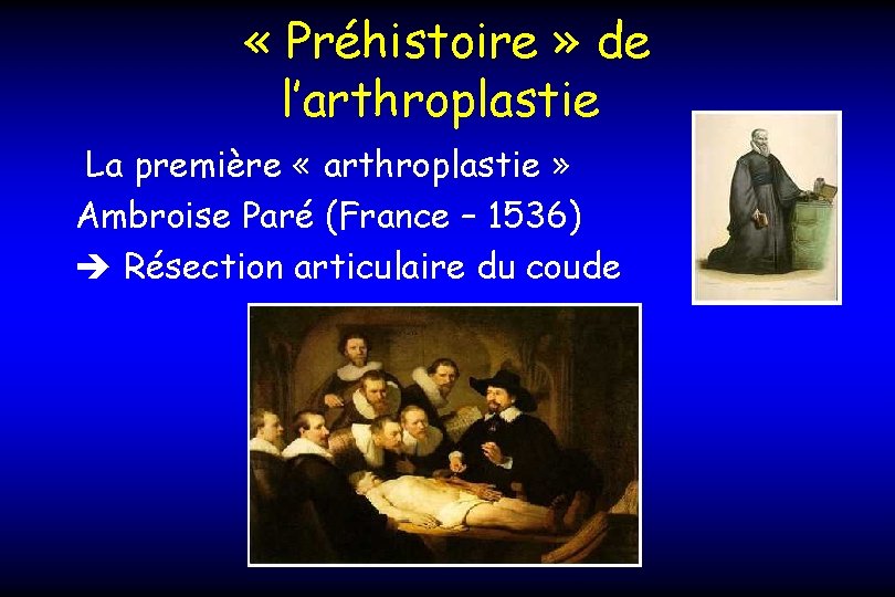  « Préhistoire » de l’arthroplastie La première « arthroplastie » Ambroise Paré (France