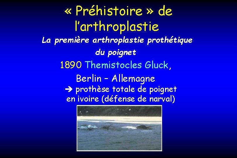  « Préhistoire » de l’arthroplastie La première arthroplastie prothétique du poignet 1890 Themistocles