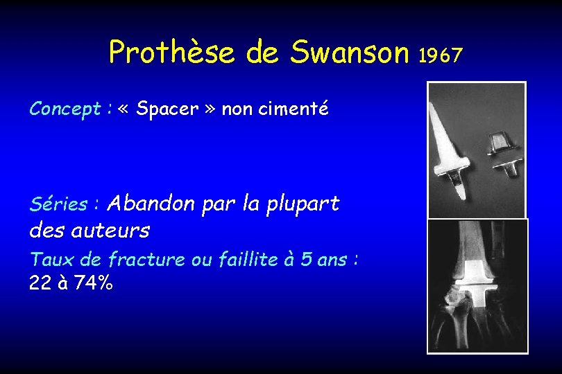 Prothèse de Swanson Concept : « Spacer » non cimenté Séries : Abandon par