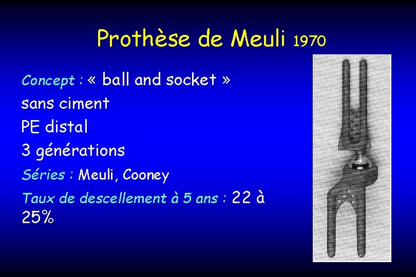 Prothèse de Meuli Concept : « ball and socket » sans ciment PE distal