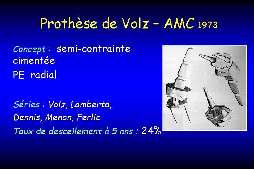 Prothèse de Volz – AMC Concept : semi-contrainte cimentée PE radial Séries : Volz,