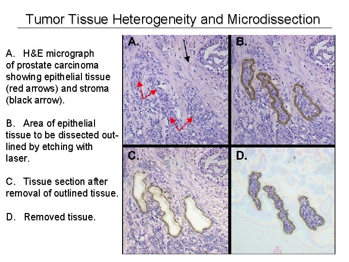 Tumor Tissue Heterogeneity and Microdissection A. H&E micrograph of prostate carcinoma showing epithelial tissue