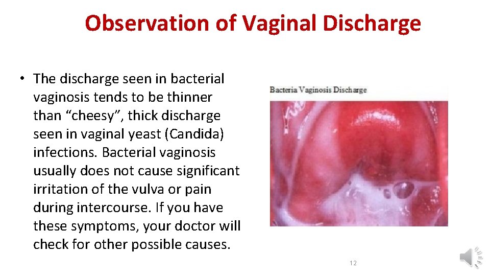 Observation of Vaginal Discharge • The discharge seen in bacterial vaginosis tends to be