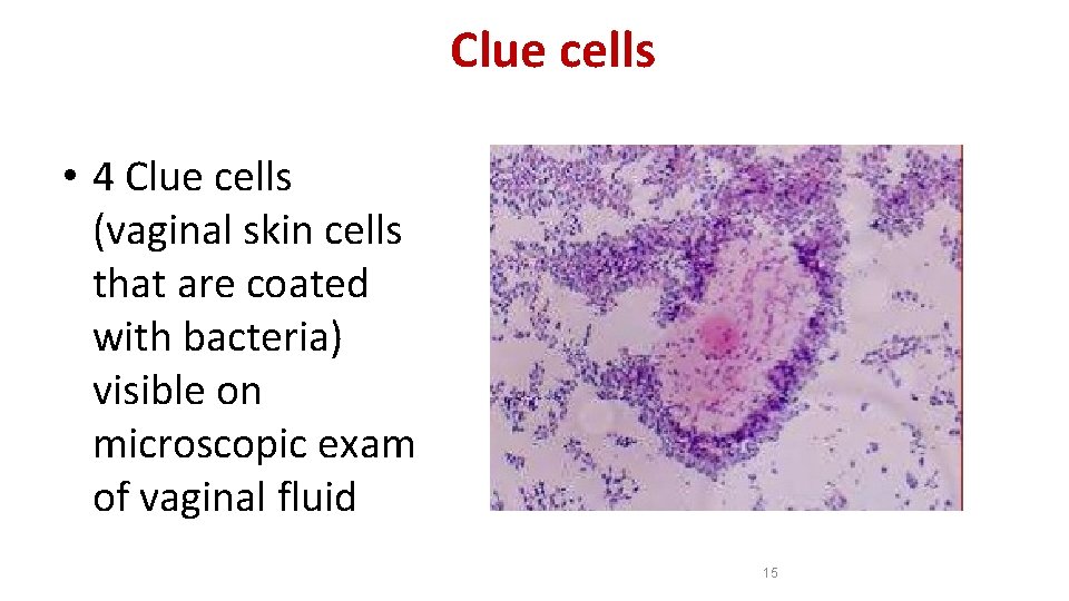Clue cells • 4 Clue cells (vaginal skin cells that are coated with bacteria)