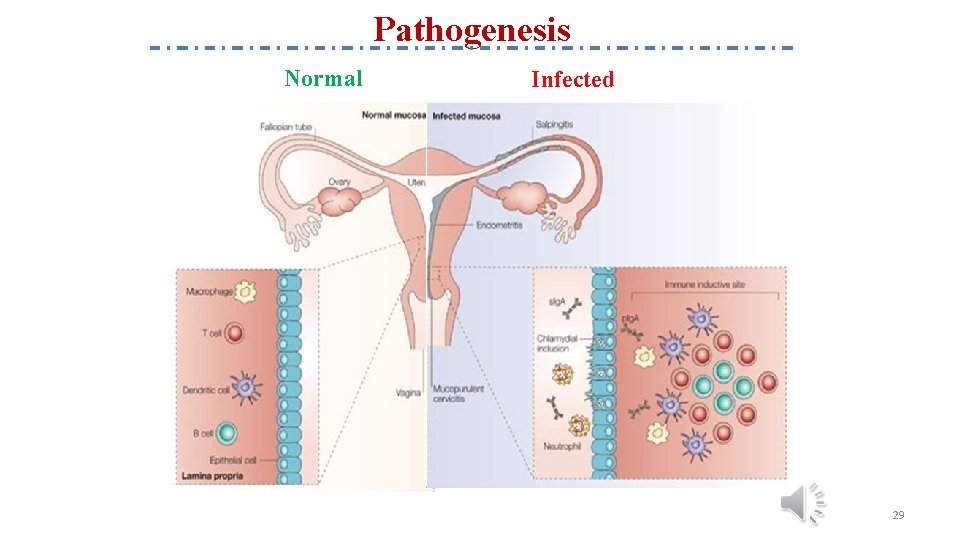 Pathogenesis Normal Infected 29 