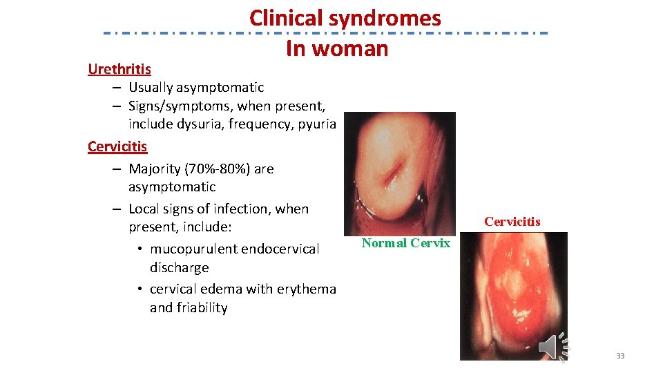 Clinical syndromes In woman Urethritis – Usually asymptomatic – Signs/symptoms, when present, include dysuria,