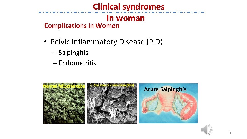 Clinical syndromes In woman Complications in Women • Pelvic Inflammatory Disease (PID) – Salpingitis