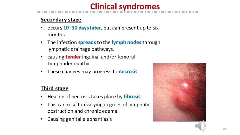Clinical syndromes Secondary stage • occurs 10– 30 days later, but can present up