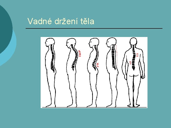 Vadné držení těla 