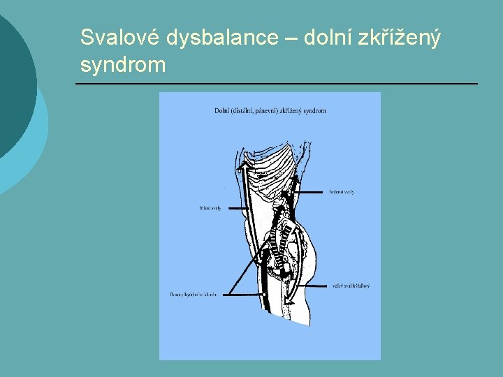 Svalové dysbalance – dolní zkřížený syndrom 