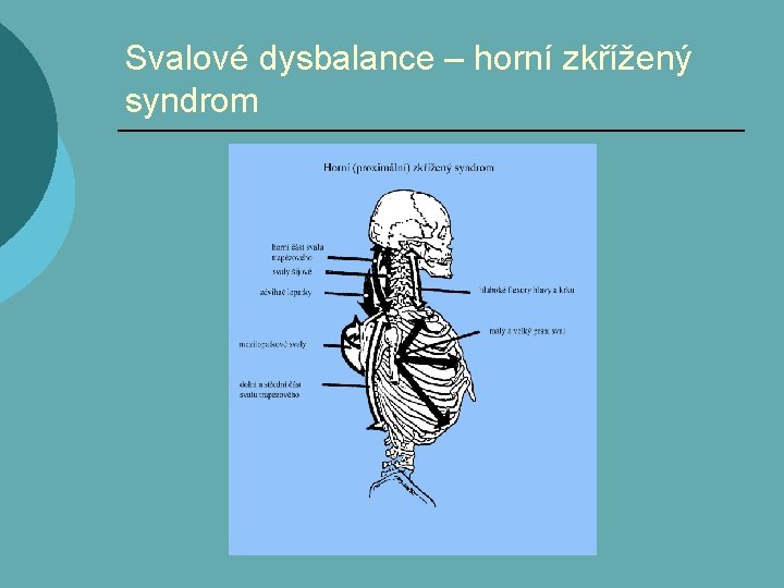 Svalové dysbalance – horní zkřížený syndrom 