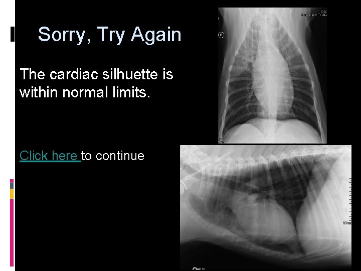 Sorry, Try Again The cardiac silhuette is within normal limits. Click here to continue