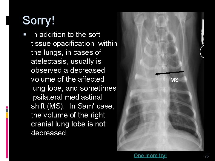 Sorry! § In addition to the soft tissue opacification within the lungs, in cases